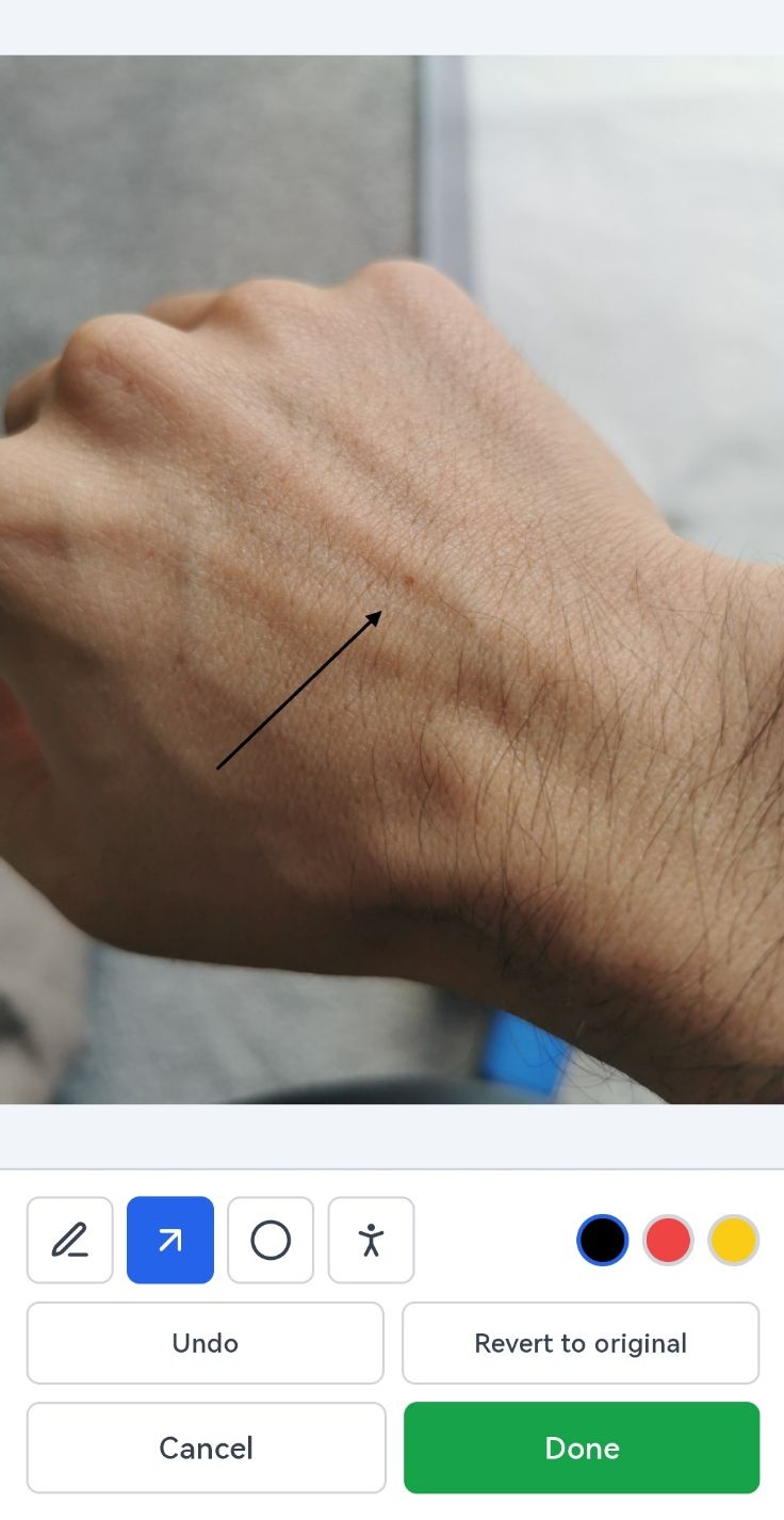 Drawing an arrow onto a clinical photo on a phone, before it is sent